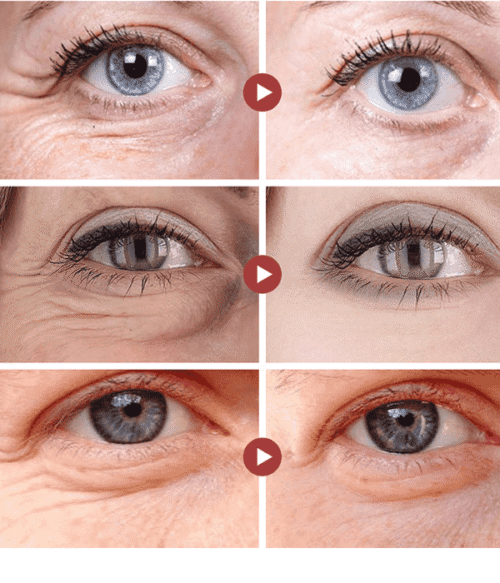 Dark circles Dark circles